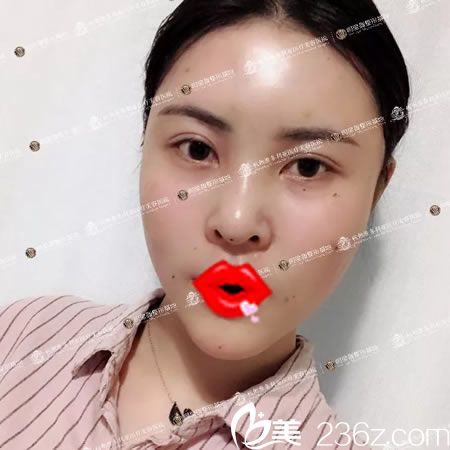 找維多利亞馬騰做脂肪填充后即刻照片