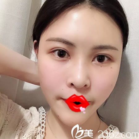 杭州維多利亞自體脂肪填充案例5天效果