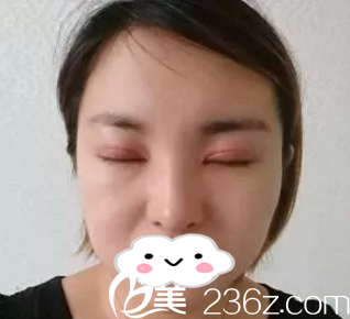 手術(shù)后第六天 手術(shù)后第六天