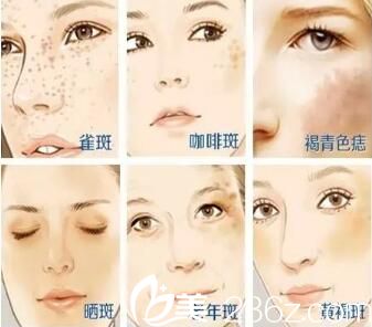 激光可以改善斑點(diǎn)的類型 激光可以改善斑點(diǎn)的類型