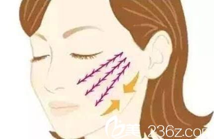 面部線雕提升原理 面部線雕提升原理