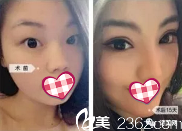 雅美整形醫(yī)院鼻部案例