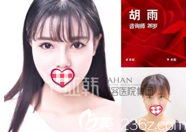 亞韓整形醫(yī)院鼻部案例
