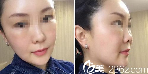 做面部自體填充術(shù)后2天