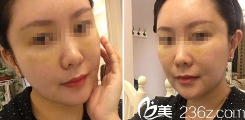 做面部自體填充術(shù)后1周