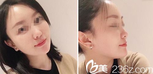 做面部自體填充術(shù)后2周