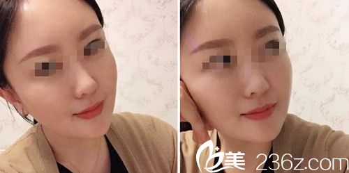 做面部自體填充術(shù)后19天