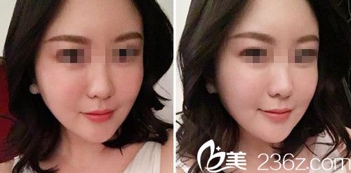 做面部自體填充術(shù)后25天