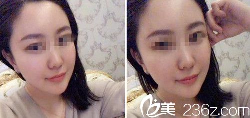 做面部自體填充術(shù)后50天