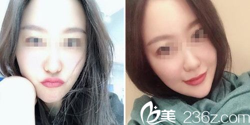 做面部自體填充術(shù)后2個月