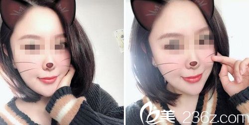 做面部自體填充術(shù)后3個月