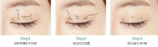 長(zhǎng)春中妍奧克拉韓式埋線雙眼皮