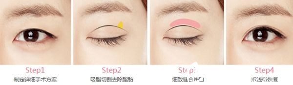長(zhǎng)春中妍奧克拉韓式切開(kāi)雙眼皮