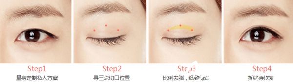 長(zhǎng)春中妍奧克拉韓式三點(diǎn)雙眼皮