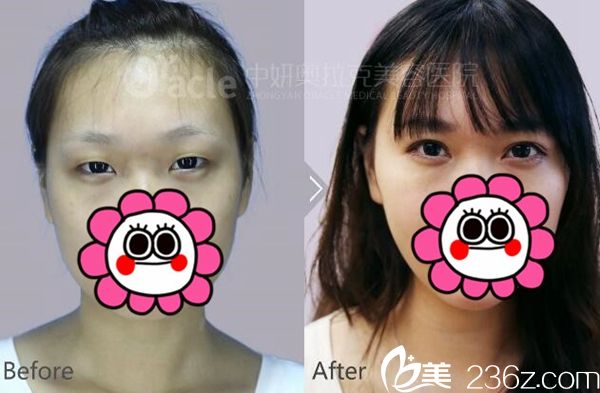 長(zhǎng)春中妍奧克拉韓式雙眼皮手術(shù)案例