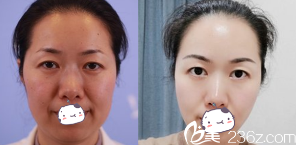 合肥白領(lǐng)安琪兒美迪塑PPDO面部提升案例效果對(duì)比圖 合肥白領(lǐng)安琪兒美迪塑PPDO面部提升案例效果對(duì)比圖