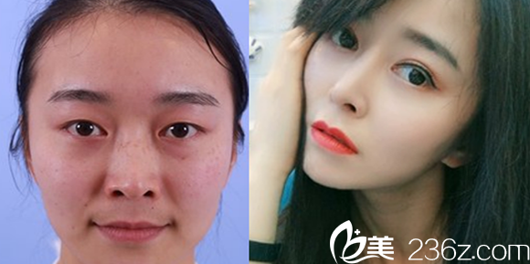 鼻綜合+眼綜合效果圖 鼻綜合+眼綜合效果圖