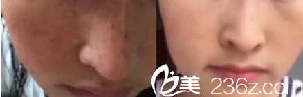 韓國Mybeauti整形外科醫(yī)院案例