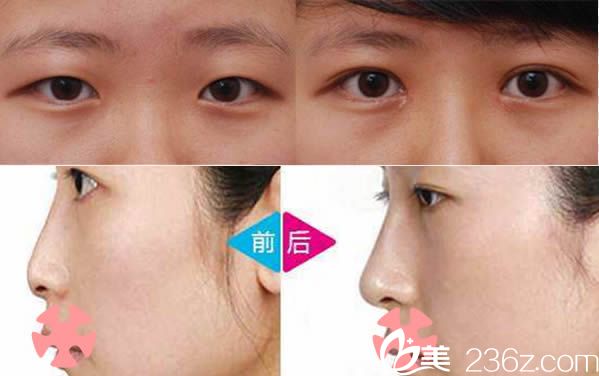 泉州東大雙眼皮和鼻綜合隆鼻<span style= 泉州東大雙眼皮和鼻綜合隆鼻<span style=