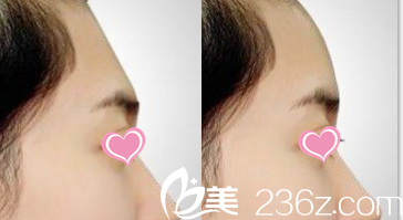 真人案例分享韓國Mybeauti整形醫(yī)院金根煥院長自體脂肪填充技術(shù)效果