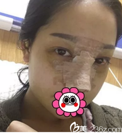 術后第四天 術后第四天