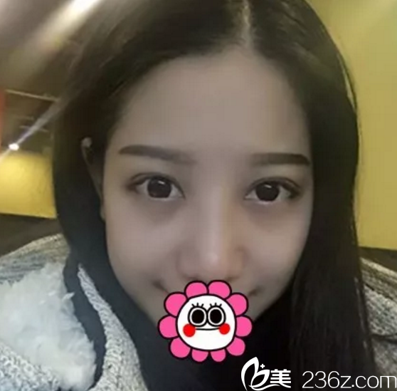 術后第三周 術后第三周