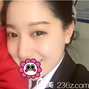 李進(jìn)進(jìn)主任整形怎么樣？鼻綜合+去眼袋真人案例