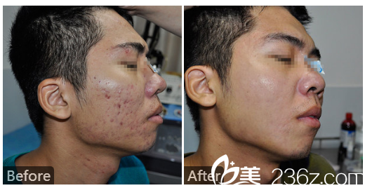  廣東藥科<!--<i data=20240709-sp></i>-->廣州復星禪誠醫(yī)院皮膚科皮膚疤痕科巫尾英醫(yī)生激光祛除痘坑實例