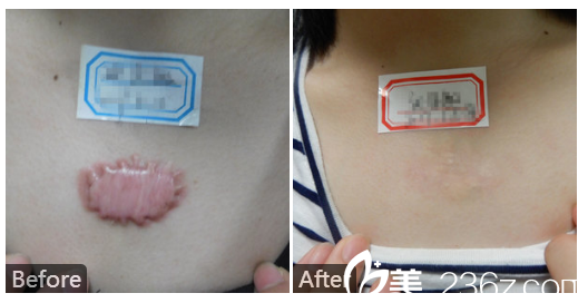  廣東藥科<!--<i data=20240709-sp></i>-->廣州復星禪誠醫(yī)院皮膚科皮膚科巫尾英好不好？看疤痕增生修復實例對比圖