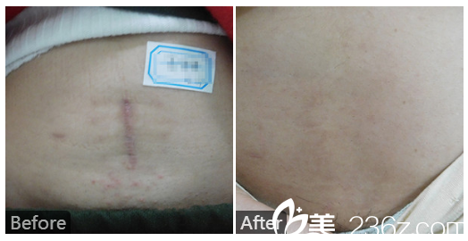  廣東藥科<!--<i data=20240709-sp></i>-->廣州復星禪誠醫(yī)院皮膚科皮膚科巫尾英怎么樣？看看剖腹產(chǎn)疤痕祛除實例