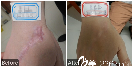  廣東藥科<!--<i data=20240709-sp></i>-->廣州復星禪誠醫(yī)院皮膚科皮膚疤痕科巫尾英手背疤痕修復實例