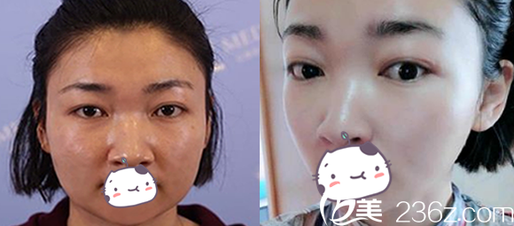 合肥白領(lǐng)安琪兒瘦臉除皺前后對比效果圖