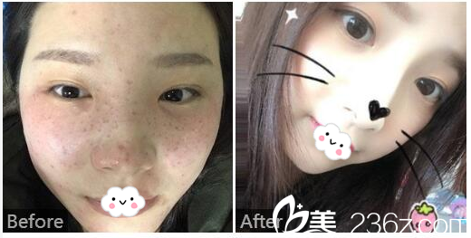  廣東藥科<!--<i data=20240709-sp></i>-->廣州復星禪誠醫(yī)院皮膚科皮膚疤痕科巫尾英醫(yī)生巫尾英皮秒激光祛斑實例