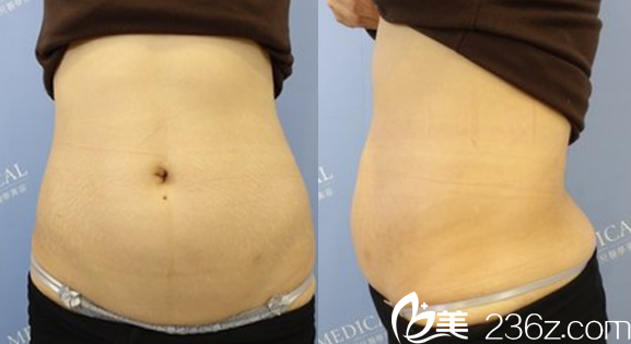 沒有去合肥白領(lǐng)安琪兒做腰部抽脂前樣子 沒有去合肥白領(lǐng)安琪兒做腰部抽脂前樣子