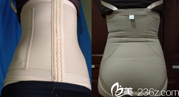 白領(lǐng)安琪兒梁啟春腰腹抽脂術(shù)后8天照片 白領(lǐng)安琪兒梁啟春腰腹抽脂術(shù)后8天照片