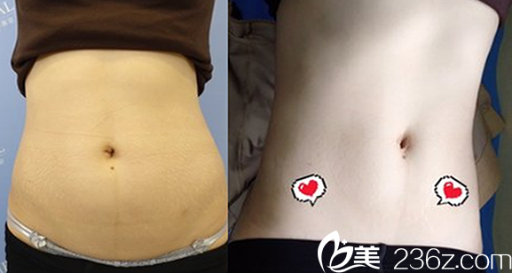 腰腹吸脂對比圖片 腰腹吸脂對比圖片