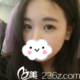 手術(shù)前貼雙眼皮貼的我 手術(shù)前貼雙眼皮貼的我