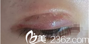 拆線當天 拆線當天