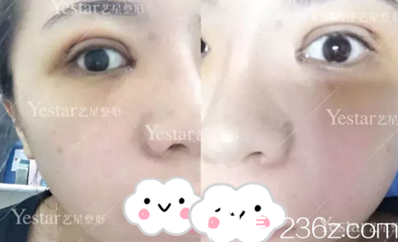 術(shù)后第七天