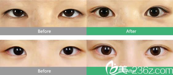 泉州東大徐海燕雙眼皮和上瞼下垂矯正案例 泉州東大徐海燕雙眼皮和上瞼下垂矯正案例