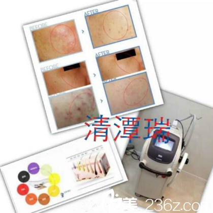 醫(yī)院IPL項目治療皮膚問題