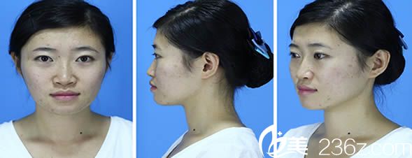 在泉州東大整形醫(yī)院做綜合隆鼻術(shù)前照 在泉州東大整形醫(yī)院做綜合隆鼻術(shù)前照