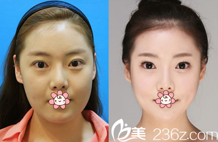 鄭潤載院長眼角修復(fù)案例 鄭潤載院長眼角修復(fù)案例