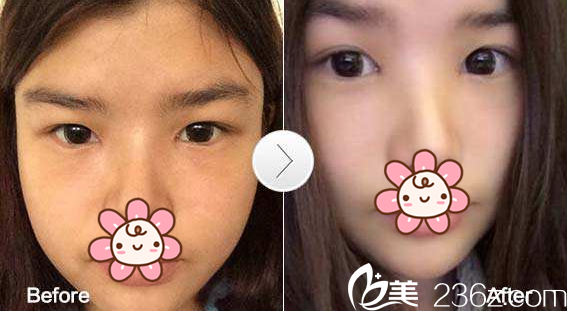 鄭潤載院長開內(nèi)眼角案例 鄭潤載院長開內(nèi)眼角案例