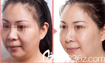 石龍杰射頻除皺案例 石龍杰射頻除皺案例