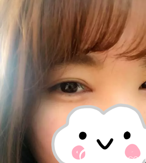 手術(shù)后第20天 手術(shù)后第20天