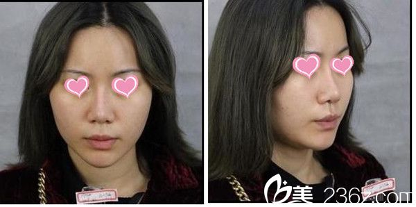 贛州亞韓整形吳禮誠隆鼻手術(shù)真人案例 贛州亞韓整形吳禮誠隆鼻手術(shù)真人案例