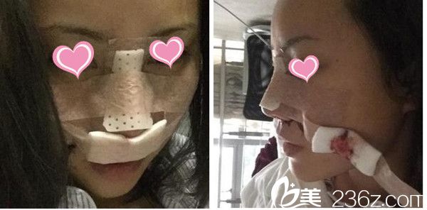 吳禮誠隆鼻手術(shù)真人案例 吳禮誠隆鼻手術(shù)真人案例