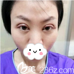 第二天去掉紗布