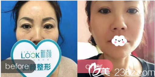 珠海新顏整形醫(yī)院<!--<i data=20240703-sp></i>-->祛眼袋案例